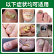 Correct onychomycosis antibacterial liquid, non-special effect, deck thickening and discoloration, nail groove fungal infection, impatiens sterilization and nail removal, 2 bottles of onychomycosis antibacterial liquid, moderate, no problem