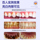 
Warronson Medical Teeth Whitening Remove Yellowing Teeth Beautifier Cold Light Whitening Artifact Gel Patch Teeth Cleaner Remove Tartar Stains