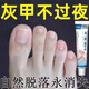 Empty, bad, thickened and yellowed herbal armor, severe onychomycosis, antiseptic liquid, brightening nail antibacterial ointment, 999+, severe and powerful