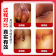 Chicao Benhara Japan imported hemorrhoid cream to eradicate genuine i-meat ball artifact internal hemorrhoids and external hemorrhoids special plaster medical gel 100% special effect severe mole hemorrhoids a box of hemorrhoid cream to quickly reduce swelling, stop bleeding, relieve pain and treat hemorrhoids