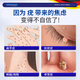 
ELSIEDOCTOR Pharmaceutical Wart Removal Cream Flat Warts Special Plantar Warts Acupuncture Warts Silk Warts Warts Spirit Neck Small Meat Neck
