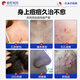 
Songcheng Pharmaceutical Folliculitis Pussy Loss Scalp Bacteria Folliculitis Folliculitis Folliculitis Fungal Infection