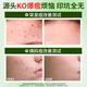 Guangdao's acne patch anti-inflammatory and pus-absorbing medical repair acne marks, remove acne and lighten acne and acne special teenagers 1 box