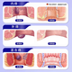 HERZFELD medical hemorrhoid gel 100% special effect, special for removing the flesh ball, internal and external mixed hemorrhoid plaster, flesh ball cutting artifact, root plug, three boxes, special for moderate recurring type