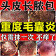 Folliculitis head medicine Folliculitis ointment Itchy scalp with pimples and redness Pimples and pustules on the head Scalp hair follicle medicine Inflammation special new validity period medicine Erythromycin ointment 3 boxes No itching anymore Highly recommended by patients Jingdong Pharmacy Official flagship store authentic Jingdong Pharmacy