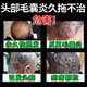Folliculitis head medicine Folliculitis ointment Itchy scalp with pimples and redness Pimples and pustules on the head Scalp hair follicle medicine Inflammation special new validity period medicine Erythromycin ointment 3 boxes No itching anymore Highly recommended by patients Jingdong Pharmacy Official flagship store authentic Jingdong Pharmacy