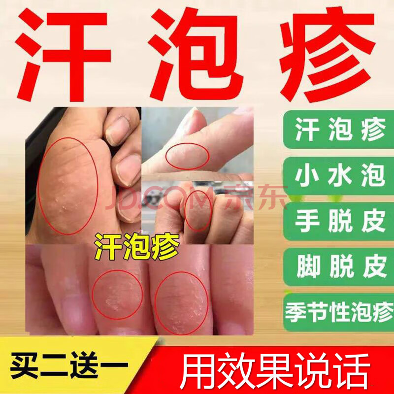 汗1皰1疹手上小水泡手癢脫皮乾裂手腳開裂膏癢真菌感染止癢鵝掌風