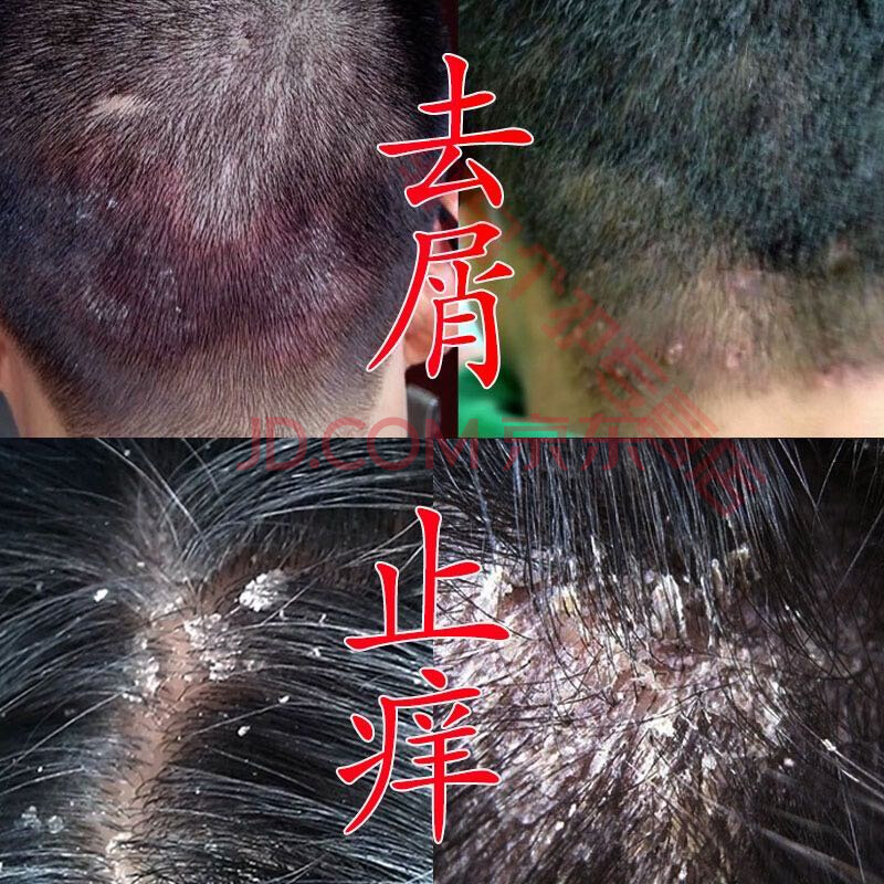 头皮屑头部脂溢性皮中洗头发毛囊洗发水