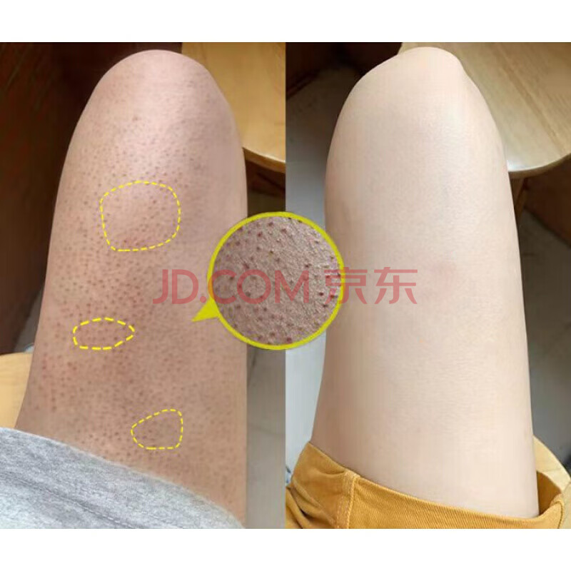 治鸡皮肤手臂训练推荐女生(鸡皮肤怎么消除最有效 手臂民间方法)