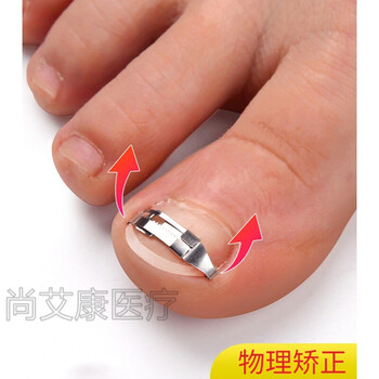 器 甲沟矫正器贴嵌甲正甲扣脚趾甲贴片长到肉里神器纠正指甲卷拉拉炎