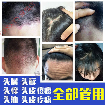 白盒淳紫乐康去屑止痒洗发水除螨虫控油去油头屑头x神器头痒洗头膏