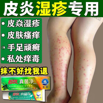 舒极真菌净膏止i痒脚臭皮l炎湿l疹荨l麻l疹牛l皮l癣膏 1盒体验