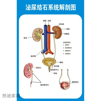 腎結石泌尿結石解剖圖醫學宣傳掛圖人體器官結構圖醫院海報牆貼紙泌尿