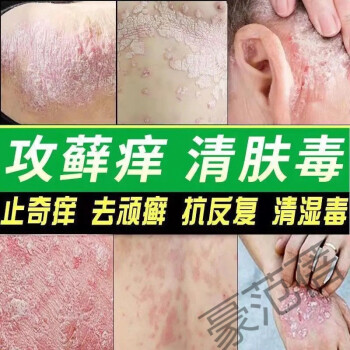 治頑固牛l皮l癬特效偏方銀l屑手足l蘚真菌感染皮膚過敏瘙癢溼l疹止癢