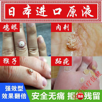 【一身无疣】克疣液脚疣平常疣喷剂除丝状扁平疣颈部候子克优液脖子疣