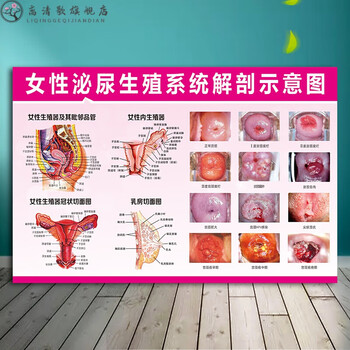 女性生殖器官图 女性泌尿生殖解剖宫颈疾病示意图妇科人体器官挂图