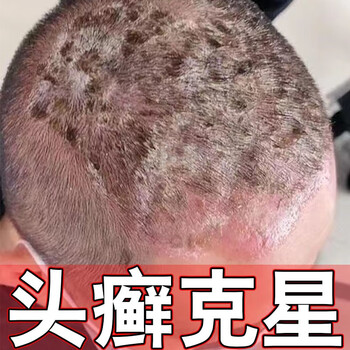 癣立净头癣专用i药银屑头皮屑脂溢性皮炎股癣手足癣真菌感染药i膏 1盒