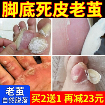 森卓老茧脚垫脚底硬皮鸡尤清茧灵正品死皮足部脚茧膏足跟脱皮非软化1盒装 图片价格品牌报价 京东