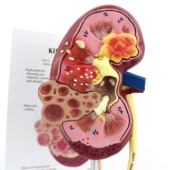 頤諾enovomedicalmodel醫學人體腎臟解剖模型腎炎腎部疾病模型腎臟