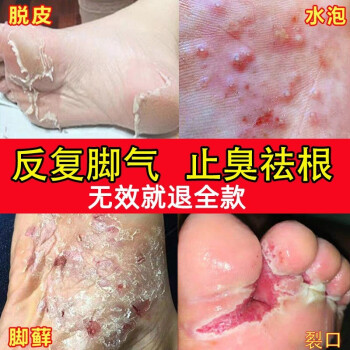 雲南本草腳氣噴劑止癢脫皮非去除腳上氣味臭腳汗水泡型腳癢腳臭汗噴霧