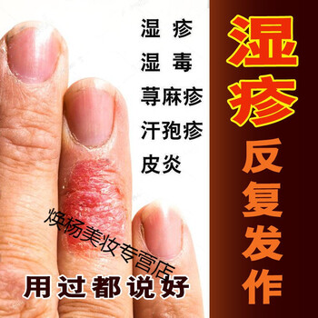 九叶苗祖湿珍疹要膏皮研炎湿珍疹止痒皮肤瘙痒汗包孢珍疹包疱珍疹荨讯
