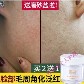 角化鸡皮肤疙瘩毛囊角质鸡皮膏去除脸上祛脸部脸颊去适用毛周角化软膏