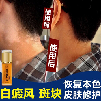 白癜风外用修复液白抑菌液白以黑养白斑净外用修复