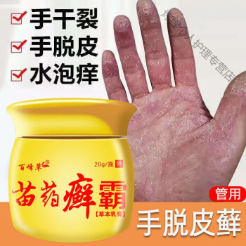 手足l癣手脱皮手痒水泡鹅掌风手l癣膏真菌感染干裂湿l疹苗箹癣霸1瓶苗