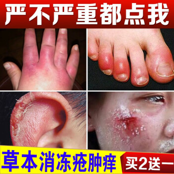 老賴鈹蛇油膏凍瘡膏腫消止癢手腳防凍傷膏護手霜男耳朵臉部兒童寶寶