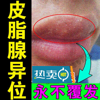 治l療皮脂腺異位嘴唇異位症增生白點乾裂脫皮紅腫上火起泡專用箹l膏