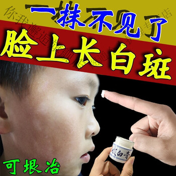 一抹消斑白色糠i疹膏儿童成人脸上有白斑长1癣单纯糠i疹虫斑20g