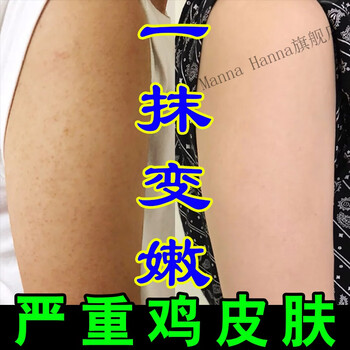 儿童鸡皮肤干燥起皮怎么办(儿童鸡皮肤干燥起皮怎么办图片)