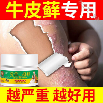 皮肤瘙痒湿l疹湿毒湿痒訷经性皮l炎手足l癣脱皮阴囊湿l疹止痒膏特l效