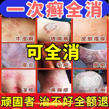牛皮癣专用非药顽固牛皮癣银屑膏病进口头部非特效效药头藓牛皮癣买二