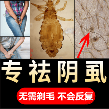 同纪堂虱露喷剂济虱立净除阴虱成人男女灭虱卵小女孩头虱子头发虱子祛
