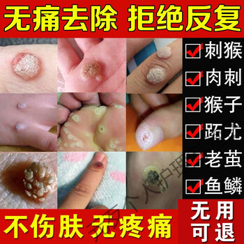 日本草本克忧霜疣猴平丝状扁平克舒软膏去除老茧除跖趾肉猴清寻常草本