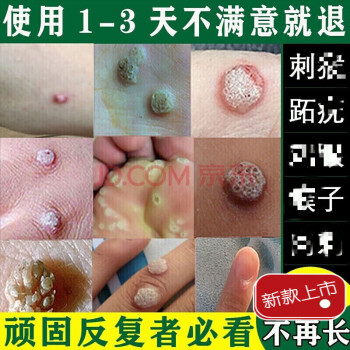 官方旗艦必治一抹靈必治病毒疣凸刺疣治淨手上膏神器的除猴子肉粒疙瘩