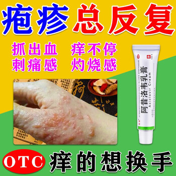 汗疱疹药膏手上起小水泡脱皮很痒汗疱疹抑菌膏手脚起水泡痒生殖器疱疹