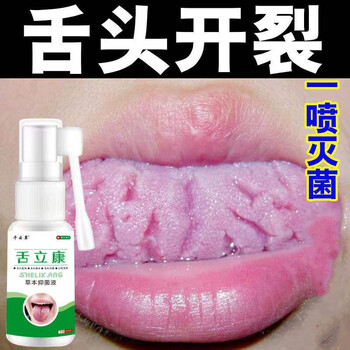 舌乳头炎舌头上火起泡舌苔发白有齿痕舌头l疼舌头开裂舌炎专用喷剂五