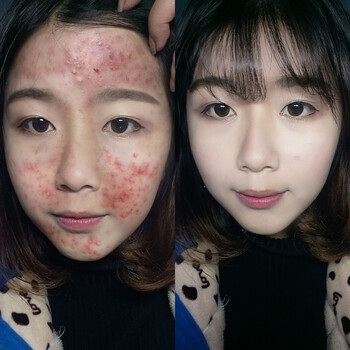 祛痘膏青春痘去痘印痘疤粉刺快速淡化男女学生青春不留