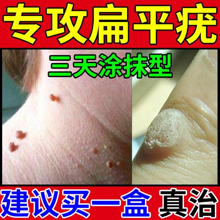 扁平疣专用药疣瘊想灵去除脖子小肉粒扁平疣特新效药维A酸乳膏去疣尖锐湿疣去脖子上的小肉粒软膏腋下去疣体 3盒装【脖子小肉粒 不美观不好看】【图片 ...