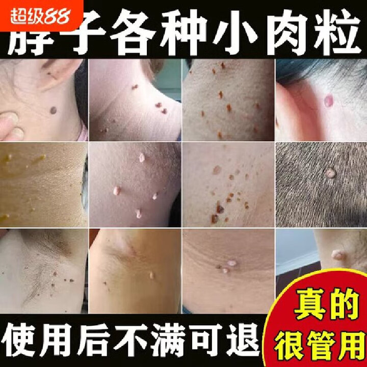 岩井昃弘疣瘊灵去除脖子小肉粒扁平疣丝状疣脖子颈部去除脱疣体专用落药膏 特效：买三送二【无痛不留痕】【图片 价格 品牌 报价】-京东