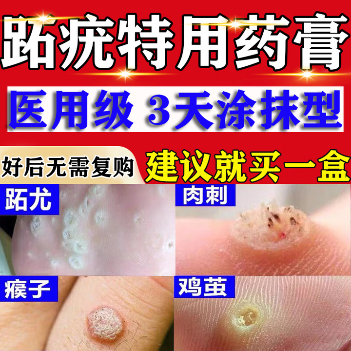 跖疣专用药跖疣脚底趾疣去鸡眼根跖疣专用特hpv贴效药感染脚掌底茧去拓疣膏刺猴专用的药寻常疣茧水杨酸软膏 3盒【长年反复疣体 起起落落】【图片 ...
