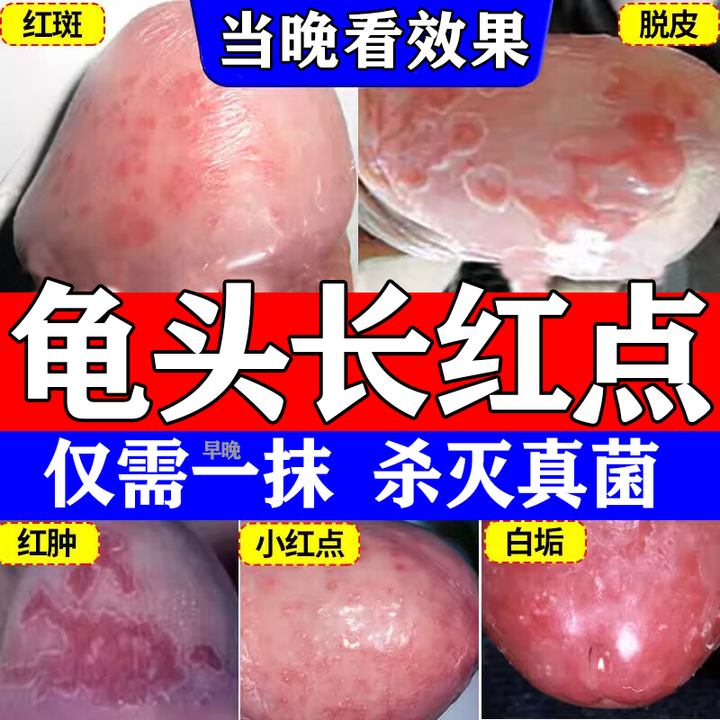 克霉唑乳膏 治龟头炎包皮炎专用药念珠菌霉菌真菌感染男性私处瘙痒止痒杀菌药膏局部红肿有异味抗菌止痒药膏 5盒装【龟头炎专用药真菌感染】【图片 ...