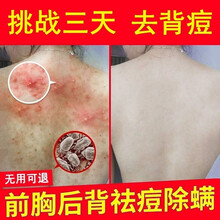 儒意茶树油非背部喷雾剂茶树精油后背产品喷雾身上胸前喷雾美背 3瓶