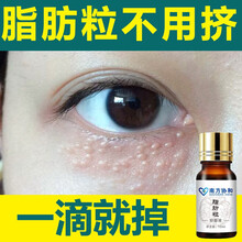 【南方协和】新款草本祛眼部油脂粒脂肪粒汗管瘤眼霜膏脂肪粒淡化黑眼圈袋眼部细纹  1瓶